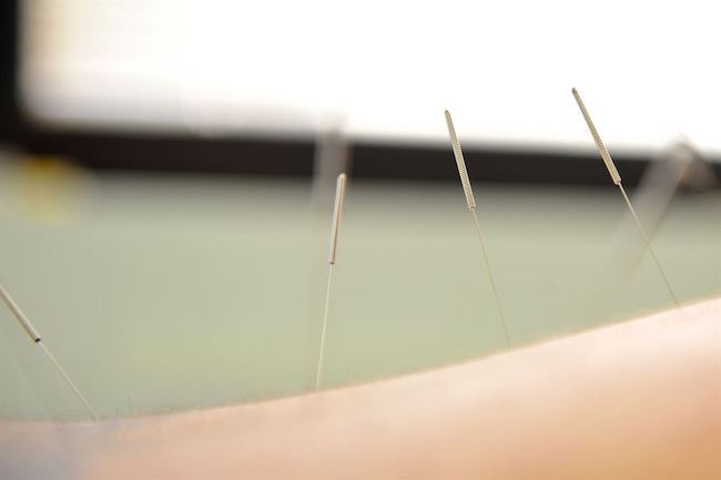 acupuncture médecine douce